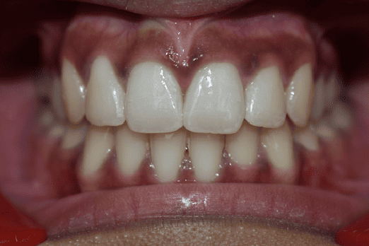 After Orthodontic Treatment - Perfect Bite and Aligned Smile