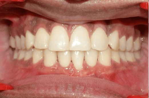 After Orthodontic Treatment - Perfect Bite and Aligned Smile