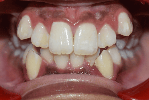 Before Orthodontic Treatment - Crooked Teeth Correction by Smiles in Motion