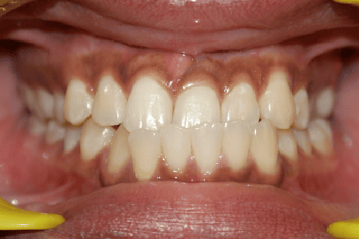 Before Orthodontic Treatment - Overbite Correction at Smiles in Motion
