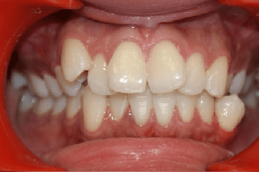 Before Orthodontic Treatment - Overbite Correction at Smiles in Motion
