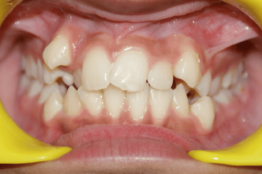 Before Orthodontic Treatment - Overbite Correction at Smiles in Motion