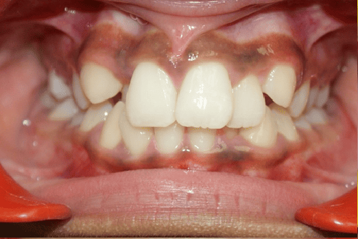 Before Orthodontic Treatment - Overbite Correction at Smiles in Motion
