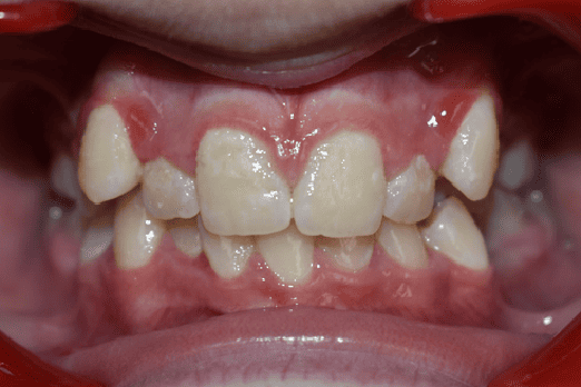 Before Orthodontic Treatment - Overbite Correction at Smiles in Motion