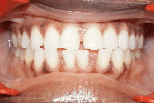Before Orthodontic Treatment - Overbite Correction at Smiles in Motion
