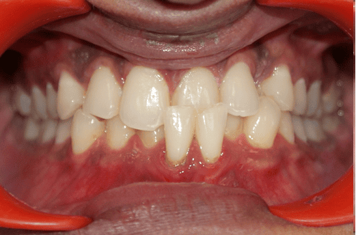 Before Orthodontic Treatment - Overbite Correction at Smiles in Motion