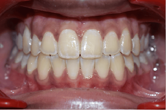 After Orthodontic Treatment - Straightened Smile by Smiles in Motion