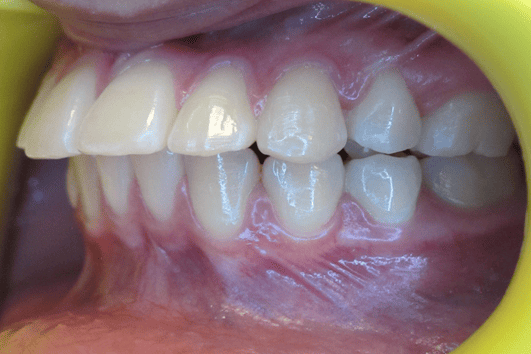 Before Orthodontic Treatment - Crooked Teeth Correction by Smiles in Motion