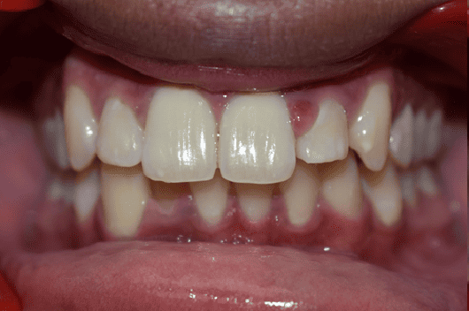 Before Orthodontic Treatment - Crooked Teeth Correction by Smiles in Motion