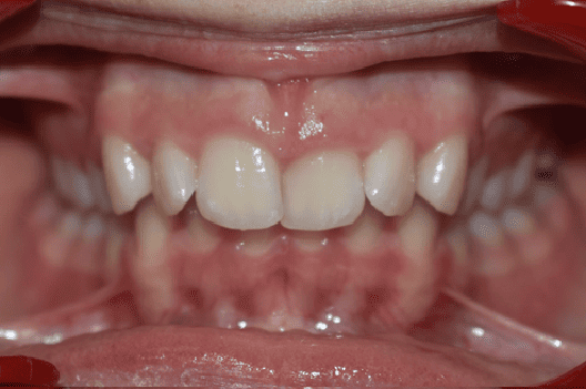 Before Orthodontic Treatment - Crooked Teeth Correction by Smiles in Motion