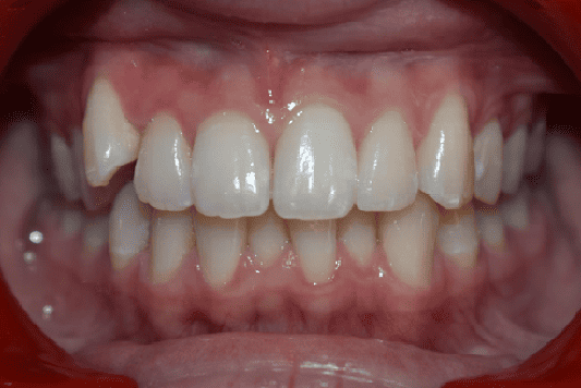 Before Orthodontic Treatment - Crooked Teeth Correction by Smiles in Motion