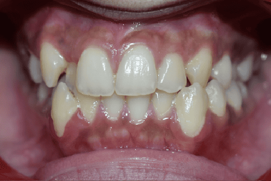 Before Orthodontic Treatment - Crooked Teeth Correction by Smiles in Motion